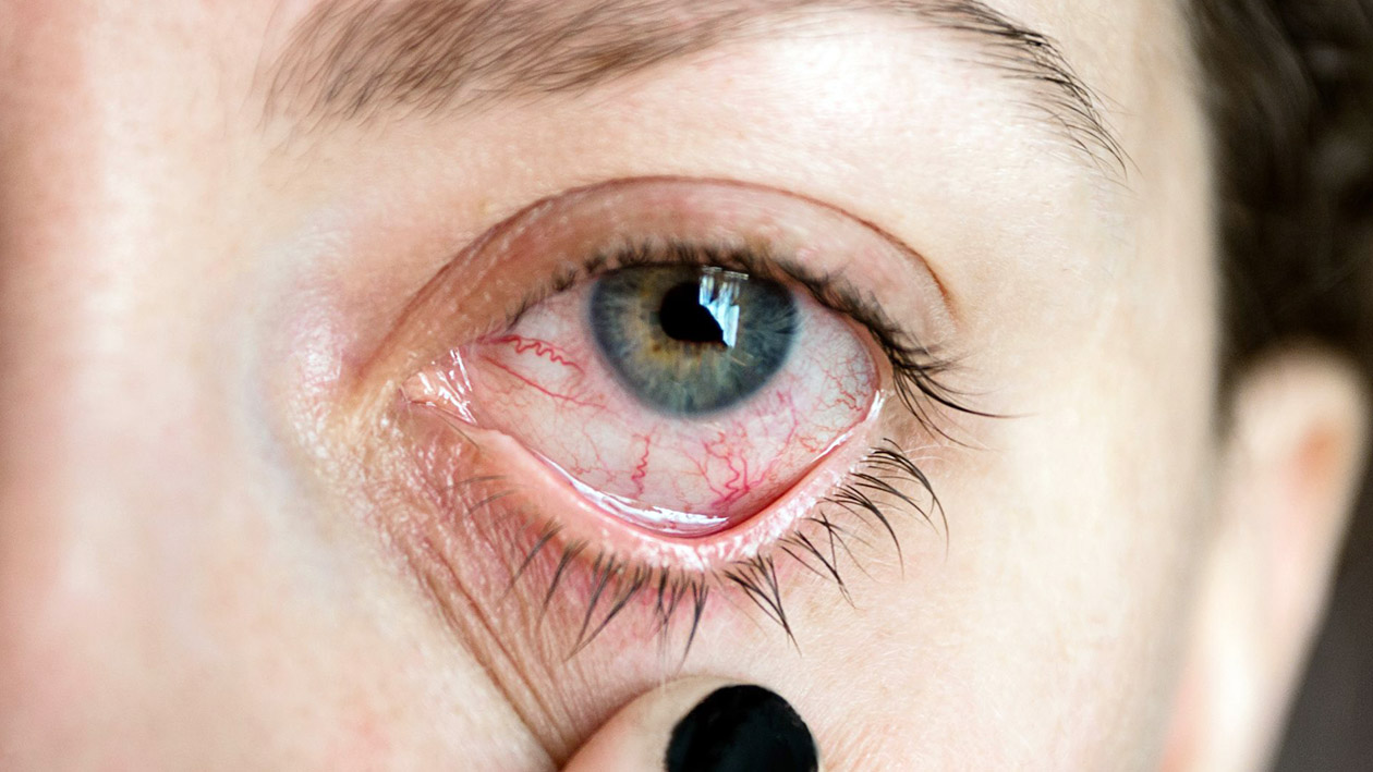 Uveitis Anterior Uveitis