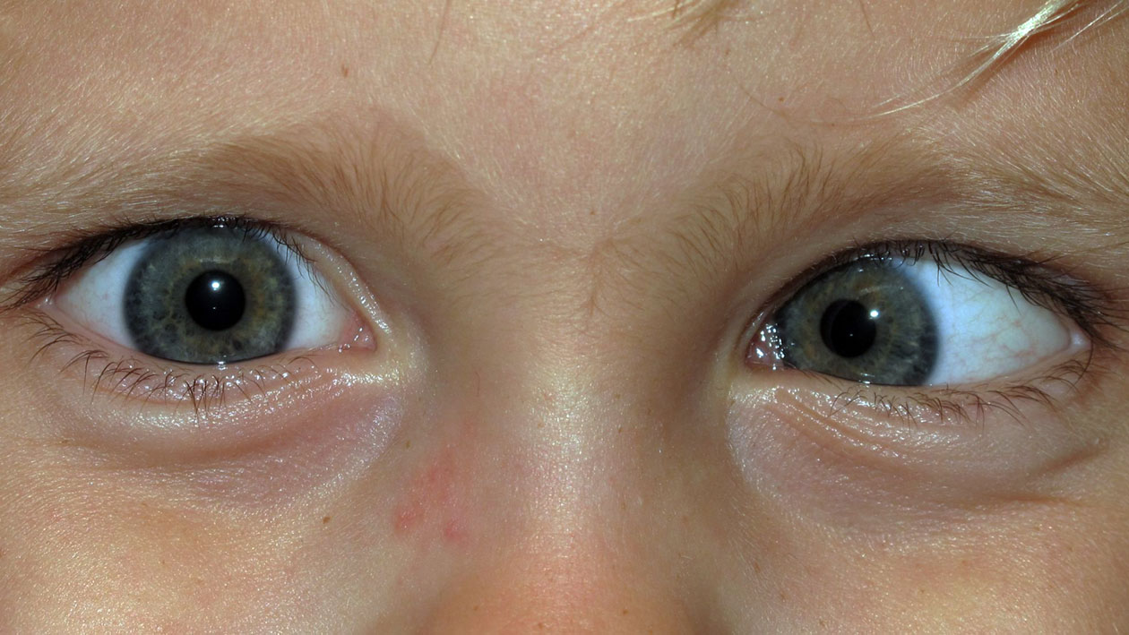 Strabismus Strabismus